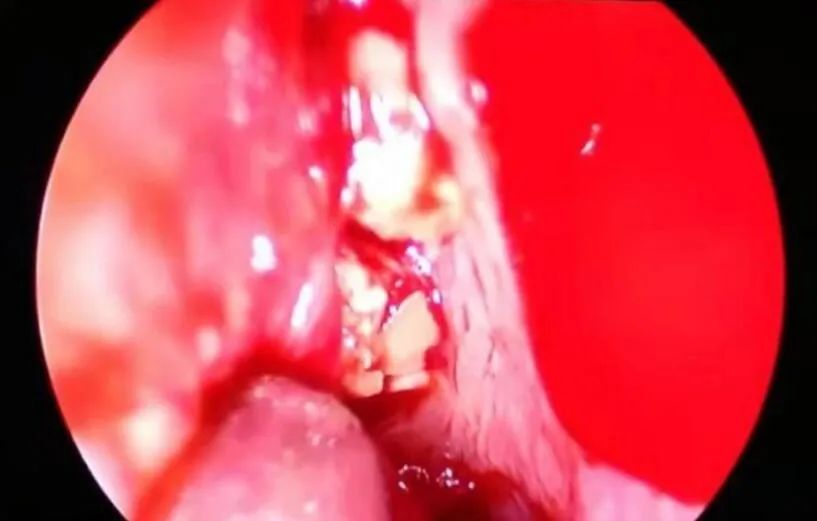 鼻塞伴有头痛吃什么药,头疼鼻塞需要吃药吗