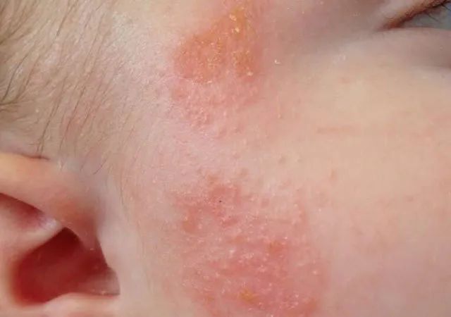 贝蒂喜益生菌可以治疗湿疹吗,汉思铂益生菌预防湿疹