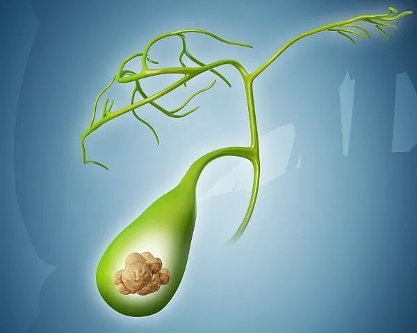 “多余的”息肉,到底会不会癌变,答案来了