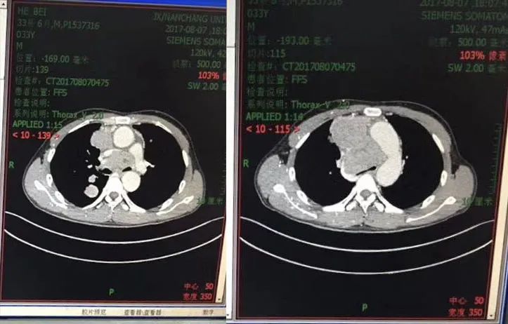33岁小伙肝癌晚期，来到江西后……
