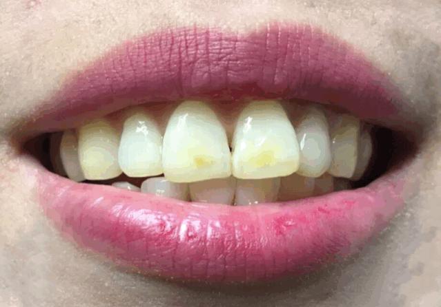 牙粉去烟渍牙结石牙膏排名第一名,美白牙膏推荐去牙黄老牌子