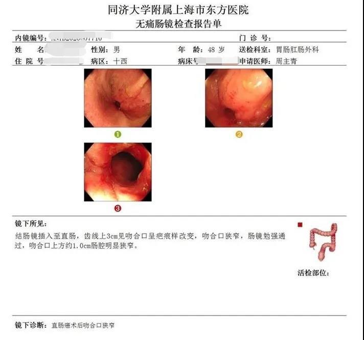 直肠癌保肛造口回肠手术风险大吗,直肠癌保肛手术吻合口狭窄