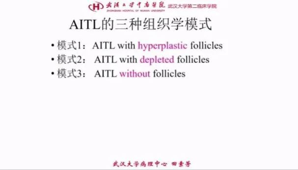 nkt细胞淋巴瘤第四期治疗病例,nkt细胞淋巴瘤第四期