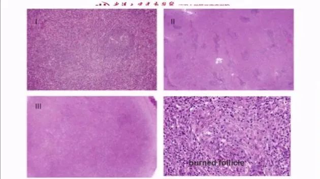 nkt细胞淋巴瘤第四期治疗病例,nkt细胞淋巴瘤第四期