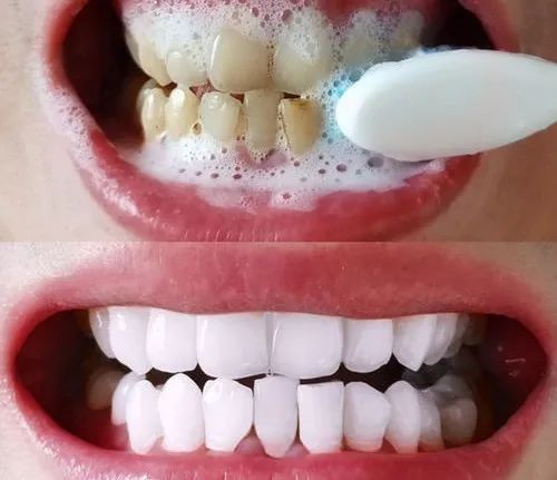 用这款神奇的专利牙膏刷一刷，3分钟KO细菌，老牙垢瞬间溶解，老黄牙不见了，多年的口臭都消失了，牙医强烈安利