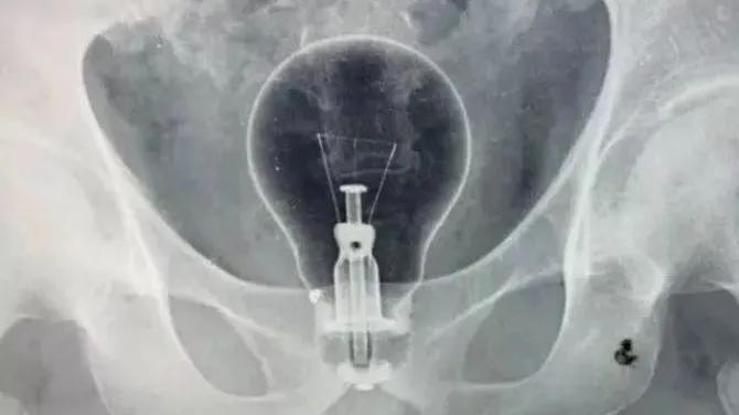 杯具！泸州男子竟将啤酒玻璃杯塞进肛门？塞入直肠的奇……