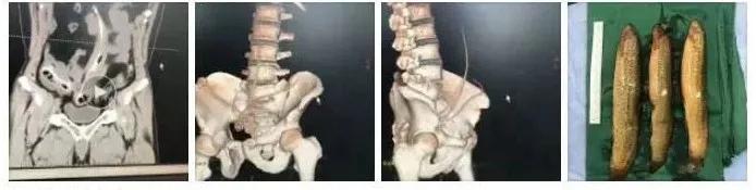 杯具！泸州男子竟将啤酒玻璃杯塞进肛门？塞入直肠的奇……