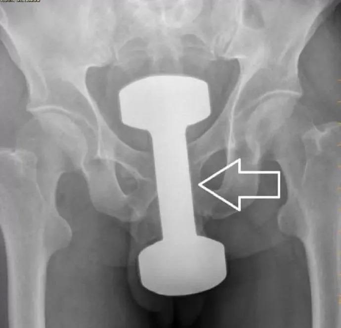 杯具！泸州男子竟将啤酒玻璃杯塞进肛门？塞入直肠的奇……