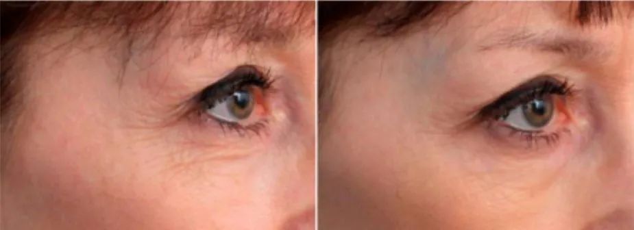 60岁没眼袋方法,教你一招去眼纹