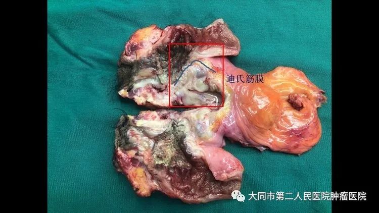 「996|身边」大同市二医院多学科合作完成我院首例腹腔镜辅助下全盆腔脏器切除术