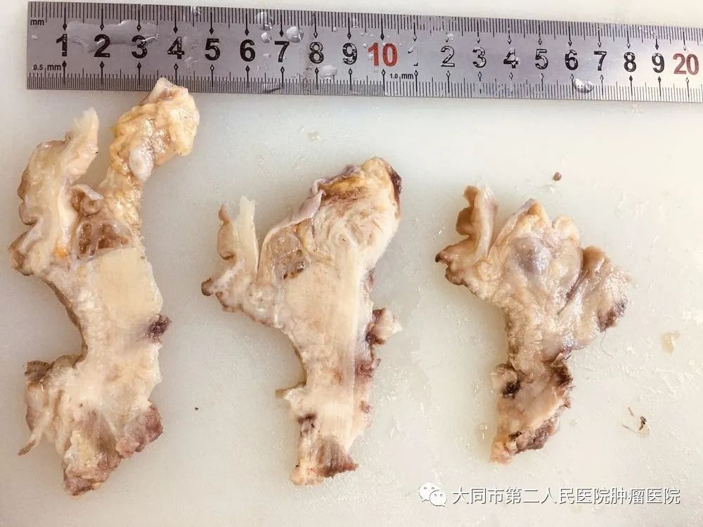 「996|身边」大同市二医院多学科合作完成我院首例腹腔镜辅助下全盆腔脏器切除术