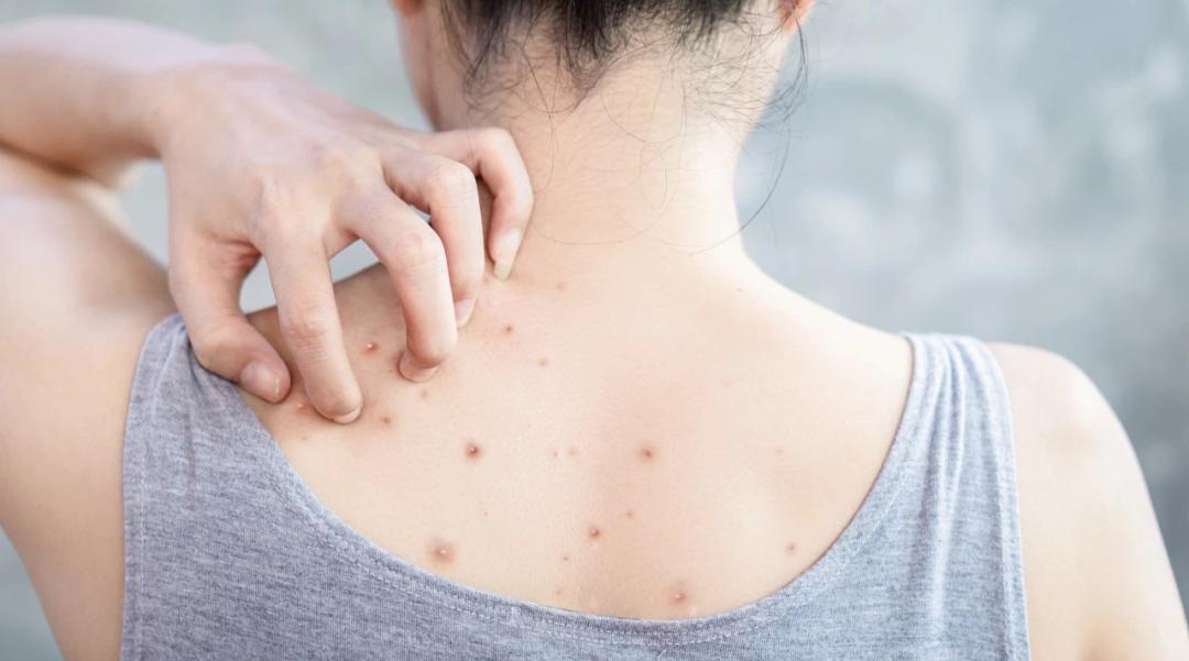 前胸后背长痘用什么药,前胸后背总是长痘怎么办