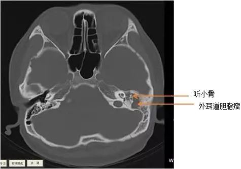 男子掏耳朵掏出黑色虫子,小伙掏耳朵掏出大秘密