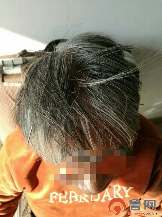 *安泰**市中医医院龙砂开阖六气针法助力脑病患者康复