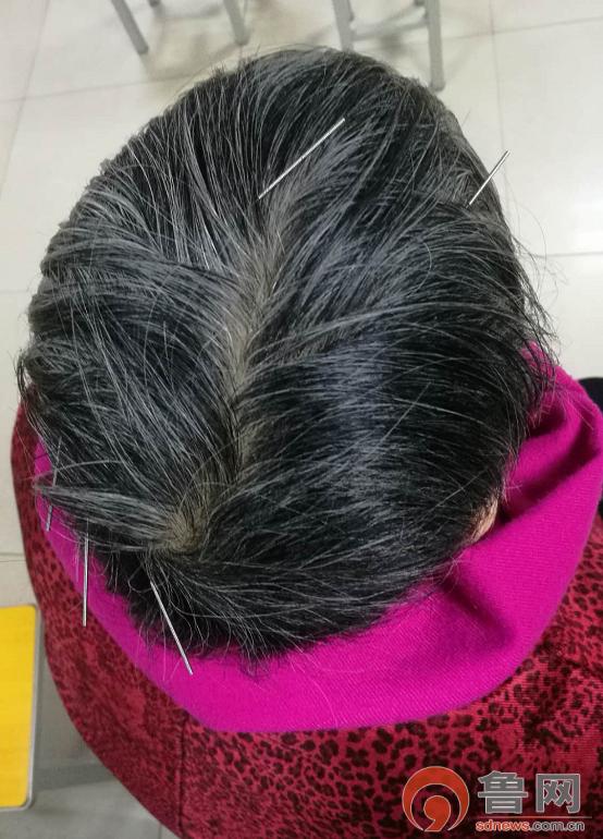 *安泰**市中医医院龙砂开阖六气针法助力脑病患者康复