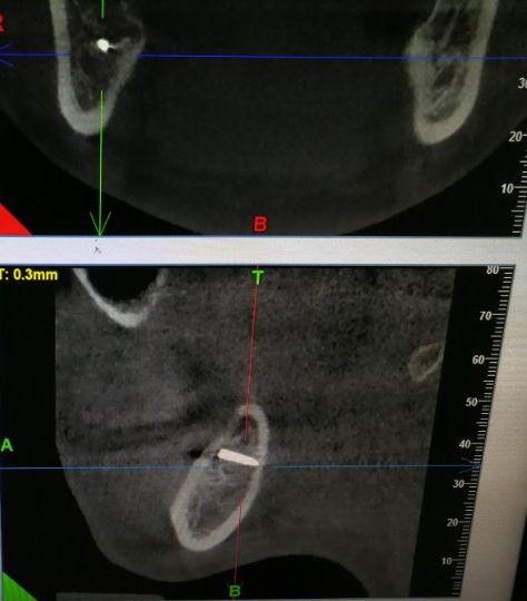 女子拔智齿后肿痛难忍检查发现,拔智齿后有异物
