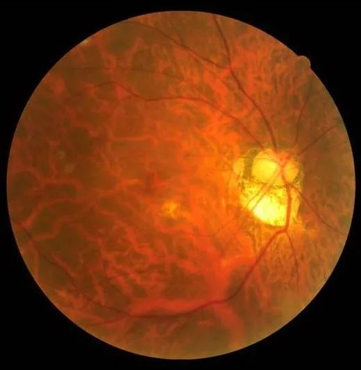 【受试者招募】经颅直流电刺激术治疗视神经萎缩患者视野缺损