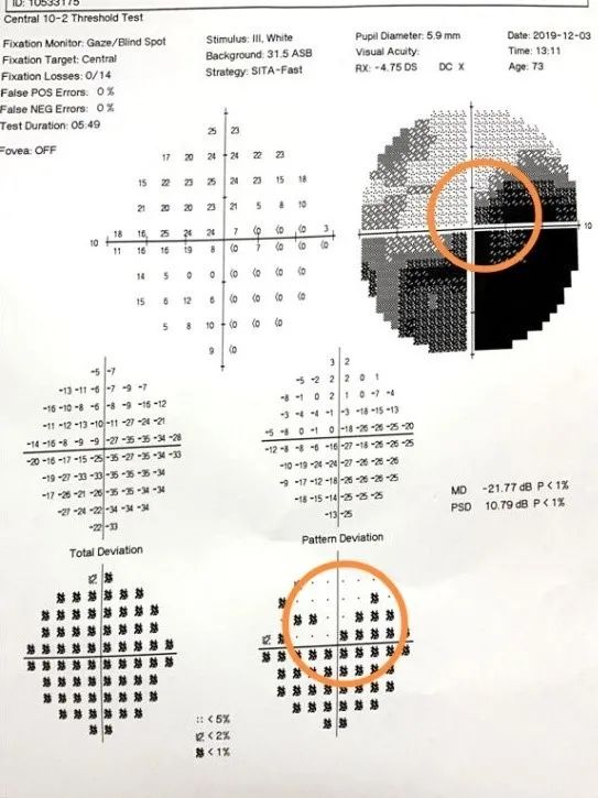 【受试者招募】经颅直流电刺激术治疗视神经萎缩患者视野缺损