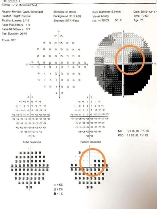 【受试者招募】经颅直流电刺激术治疗视神经萎缩患者视野缺损