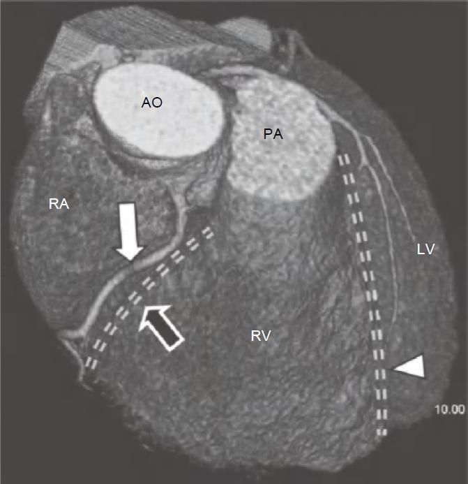 冠脉ct血管示意图的亮点是什么,冠脉血管造影识图
