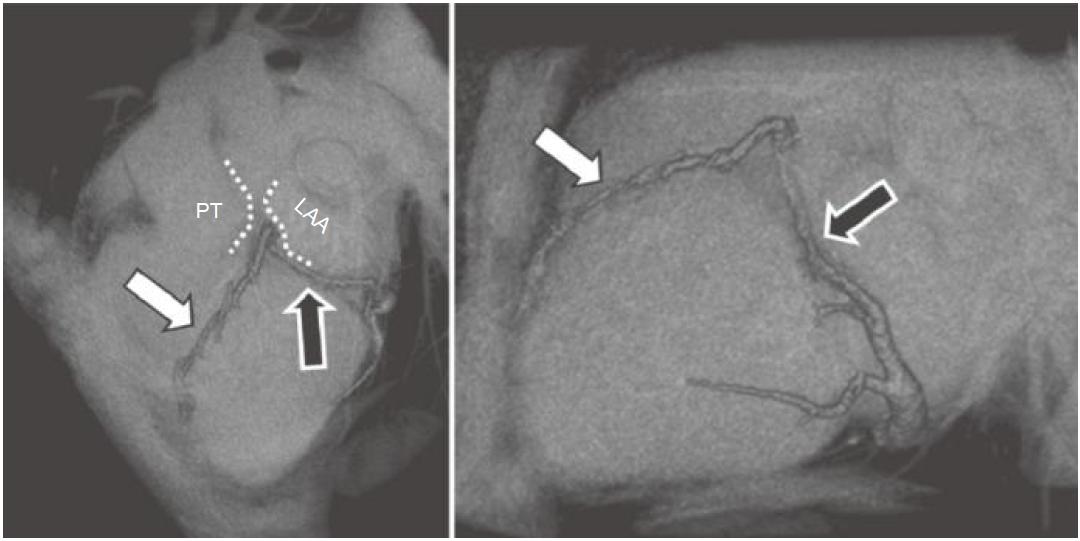 冠脉ct血管示意图的亮点是什么,冠脉血管造影识图