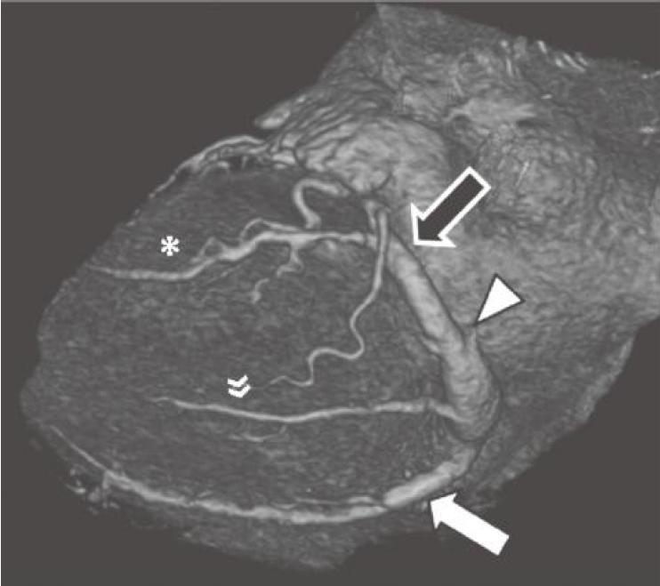 冠脉ct血管示意图的亮点是什么,冠脉血管造影识图