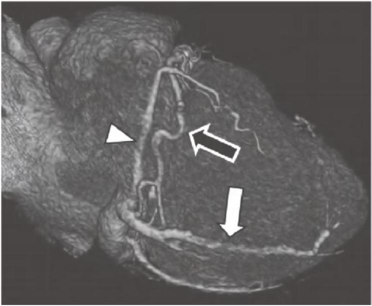 冠脉ct血管示意图的亮点是什么,冠脉血管造影识图