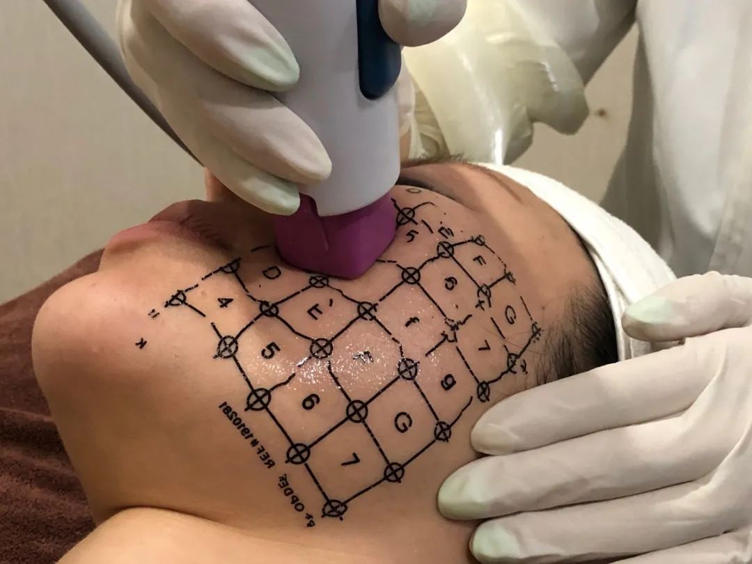 网红热玛吉效果怎么样,成都妹子素颜