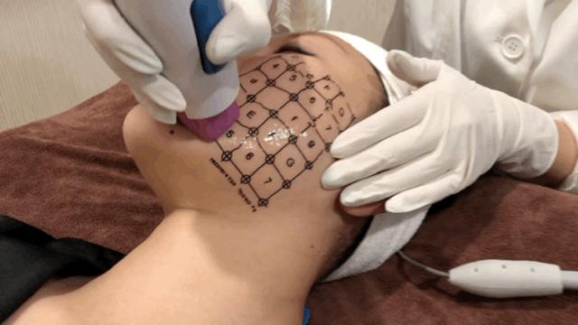 网红热玛吉效果怎么样,成都妹子素颜