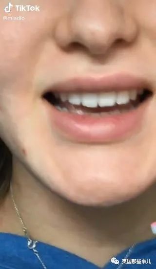外网年轻人流行用指甲锉磨牙正畸，把正经牙医都急坏了