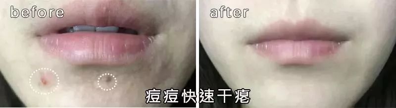 祛痘痘痘印最有效的国货产品,老国货治痘痘