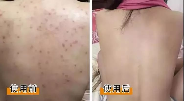 祛痘痘痘印最有效的国货产品,老国货治痘痘