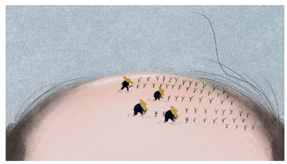 拯救发际线的最佳方法,怎么拯救m型高发际线