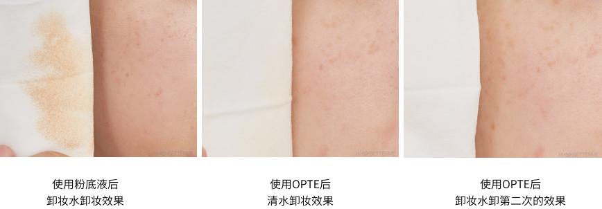 去斑点最有效方法医美去除斑痕,脸上暗沉有斑点可以做什么医美