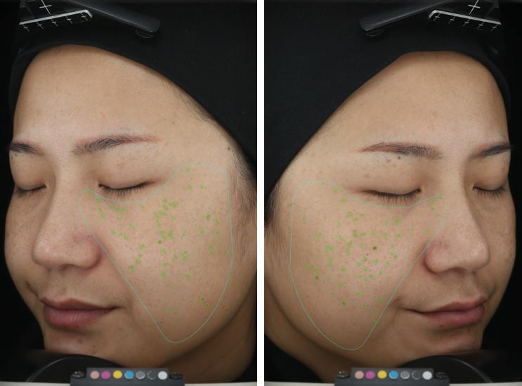 去斑点最有效方法医美去除斑痕,脸上暗沉有斑点可以做什么医美