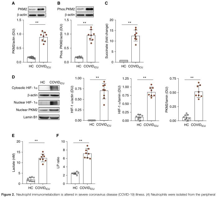 严重COVID-19疾病的炎症反应有哪些特征？｜前沿速递