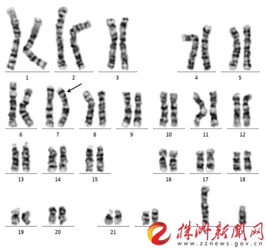 世界首例染色体,全世界第一次发现的基因突变
