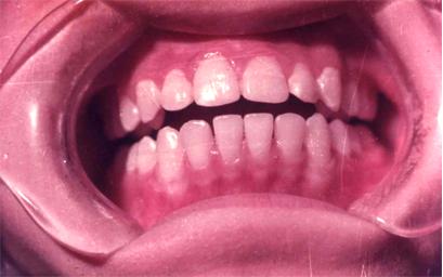 地方病防治宣传核心信息—碘缺乏病、包虫病、地方性氟中毒