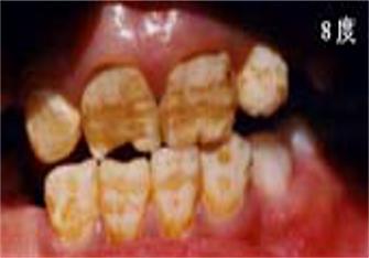 地方病防治宣传核心信息—碘缺乏病、包虫病、地方性氟中毒