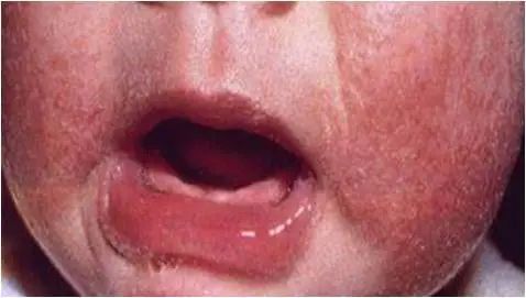 打疫苗过敏症状有哪些,食物过敏可以医好吗