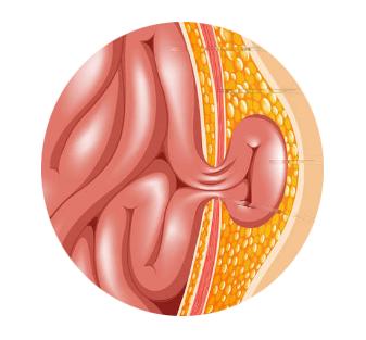 大腿根长个硬包好几天了,大腿根长了个包是怎么回事