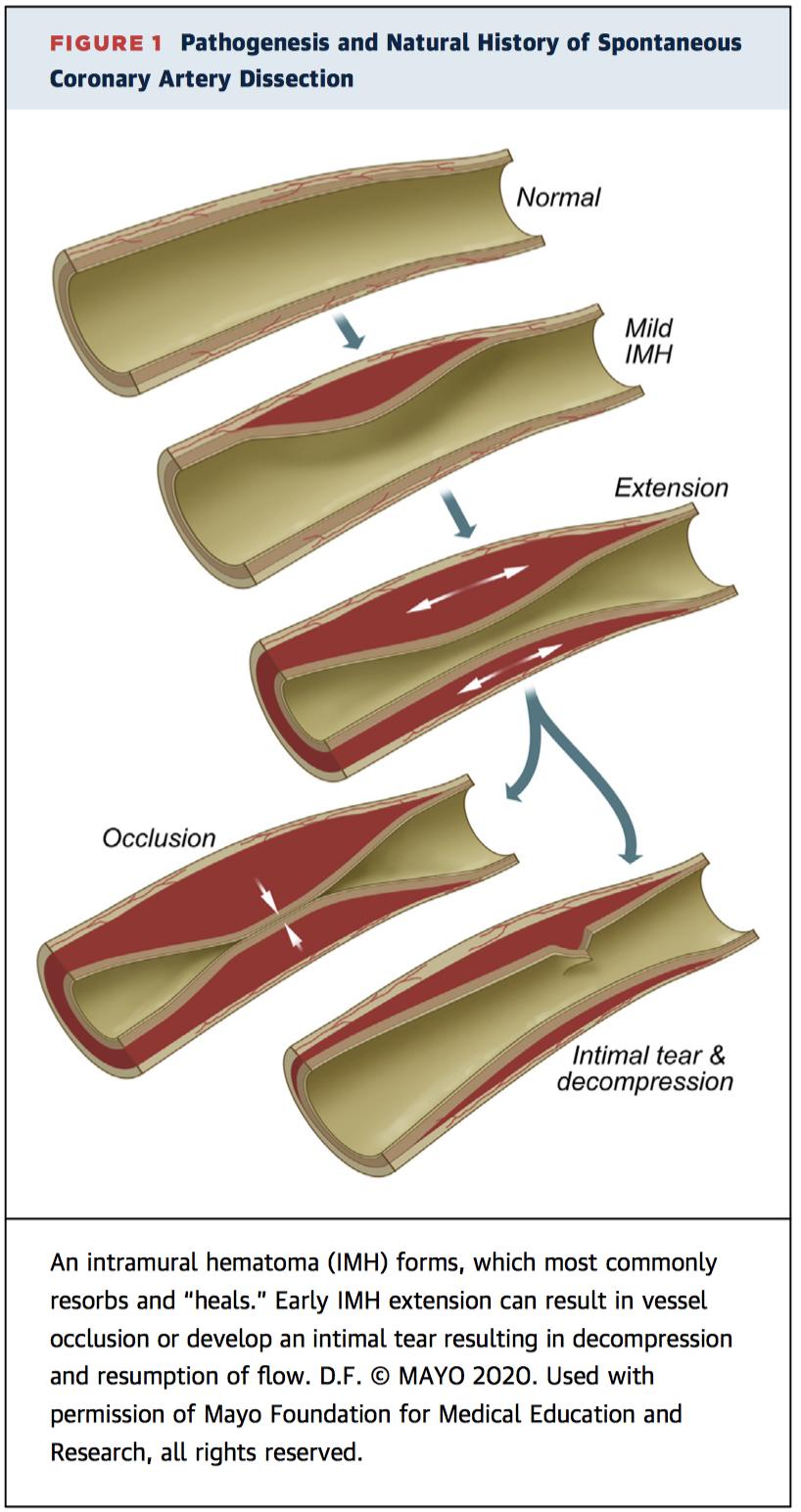 冠状动脉夹层症状和治疗,自发性冠状动脉夹层斑块破裂