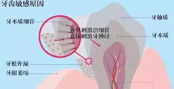 牙齿酸用抗敏感牙膏有效,抗牙本质敏感牙膏