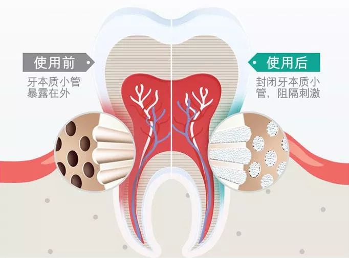 牙齿酸用抗敏感牙膏有效,抗牙本质敏感牙膏