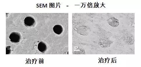 牙齿酸用抗敏感牙膏有效,抗牙本质敏感牙膏