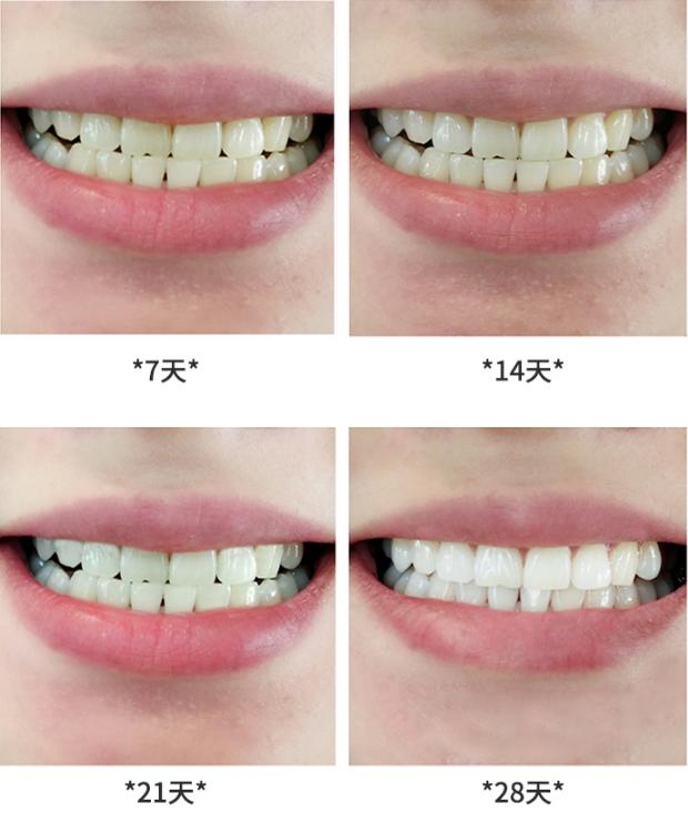 牙齿酸用抗敏感牙膏有效,抗牙本质敏感牙膏