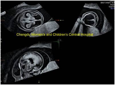 核磁确诊胎儿神经系统异常,胎儿中枢神经异常超声