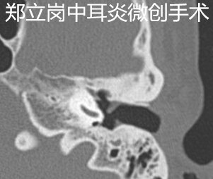 乳突炎中耳炎要做耳内镜吗,中耳乳突炎耳内镜手术