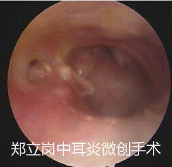 中耳炎穿孔微创手术要剃头发吗,中耳炎鼓膜穿孔湿耳可以做手术吗