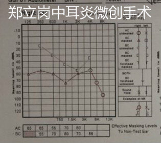 中耳炎穿孔微创手术要剃头发吗,中耳炎鼓膜穿孔湿耳可以做手术吗